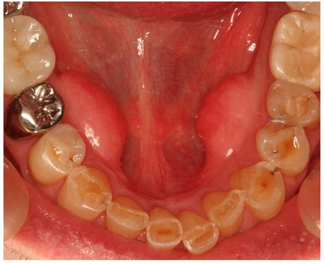 Prevalence, Characteristics, and Dynamics of Mandibular Tori in a Southern German Population: A ...