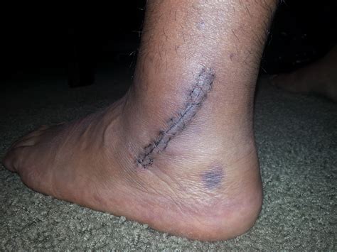 Peroneal Tendon Surgery Recovery: Ankle Time Line (updated for week 10/11)