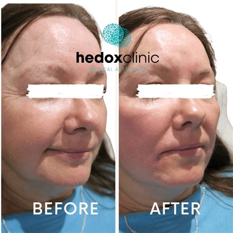 Do Cheek Fillers Lift Marionette Lines at Gary Delariva blog