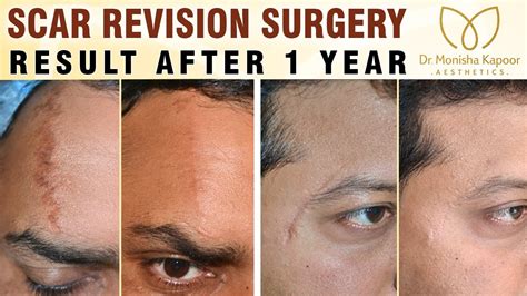 Face Scar Surgery Cost In India at Anthony Monroy blog