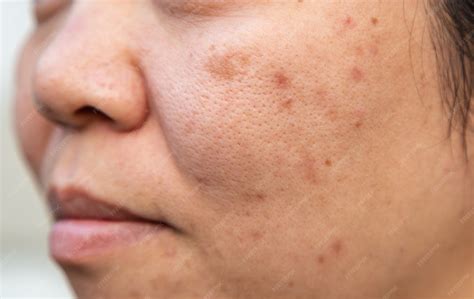 Problems facial skin is acne and blemishes. | Premium Photo