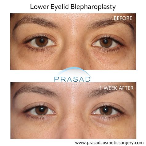 Eye Bag Removal Surgery: Procedure, Risks, Recovery