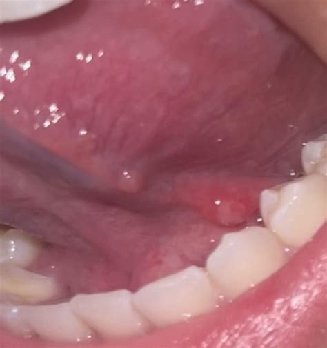 Bony Bump Under Tongue Canker Sore Vs. Cancer: Is Your Mouth Sore