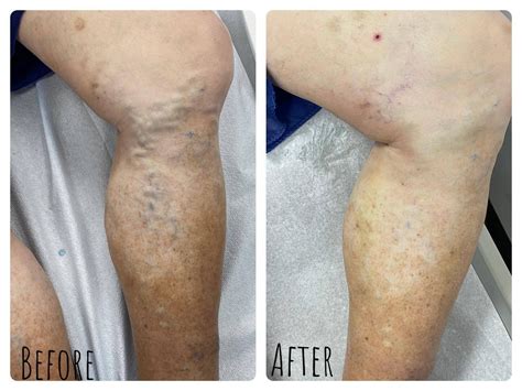 Nuevos Tratamientos Para Las Varices Escleroterapia En Caracas: