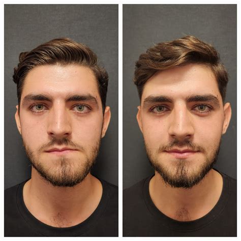 TMJ Surgery Before and After Photos – Prof. Dr. Celal Çandırlı