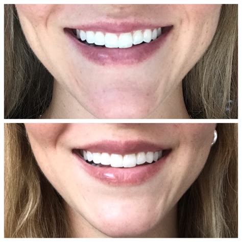 Botox Lip Flip Before And After at Andre Mccann blog