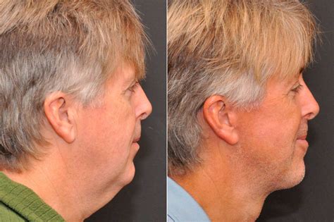 Chin Surgery Men