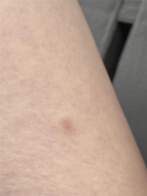 Small lump on inner thigh : r/medical_advice