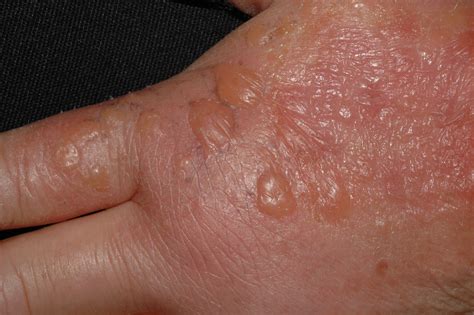 Dermatitis vesiculosas, pustulosas o exudativas de las manos archivos - Dermatopharm