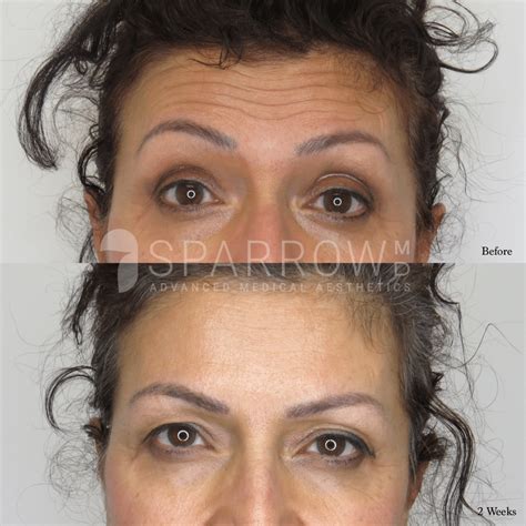 Botox Forehead Wrinkles Vancouver