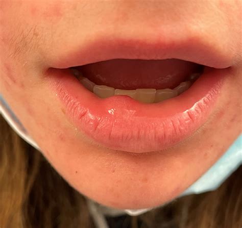 What Factors Influence Mucocele Recurrence? - Oral Surgery, Oral Medicine, Oral Pathology and ...