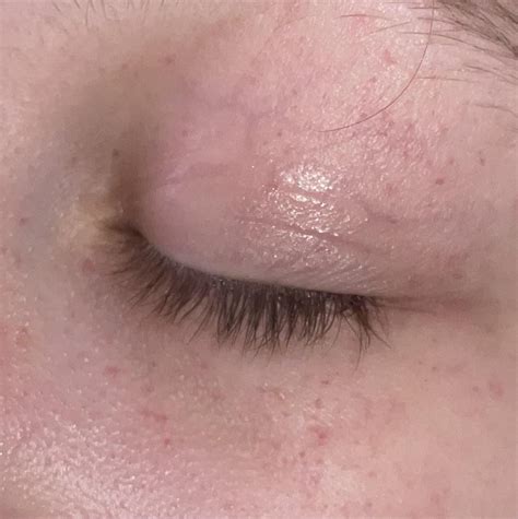 Vomiting after drinking water : r/medical