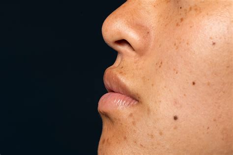 What Causes Dark Spots on Your Face? Common Causes Explained