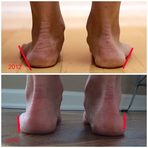 Overpronation Of The Foot | Lizzette Valcourt