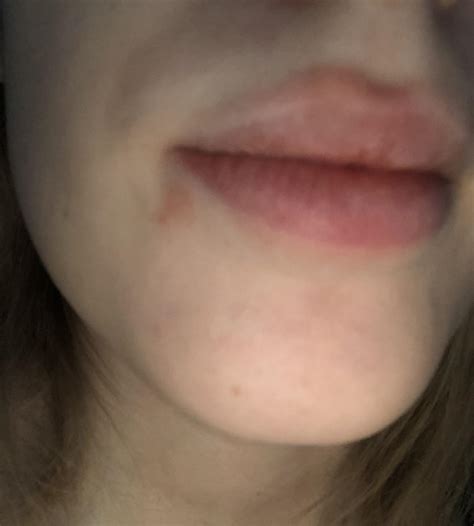 What is this weird rash around mouth? : r/DermatologyQuestions