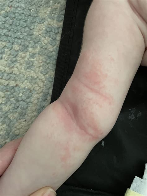 How To Recognize a Milk Allergy in Your Baby - Baby Chick