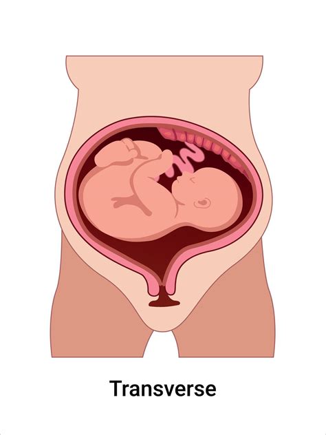 Transverse Baby Position