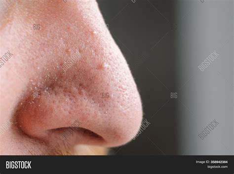 Clogged Pores Cheeks