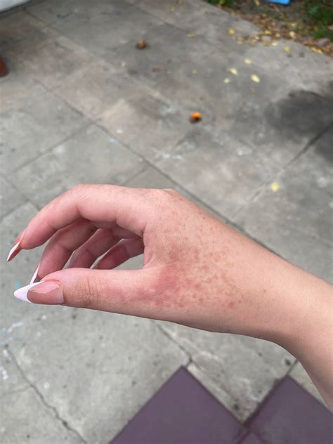 Skin rash after tanning booth. Anyone on here deal with this before ...