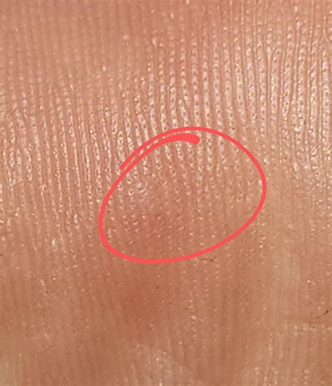 Painful... Callus or baby wart? : r/Warts