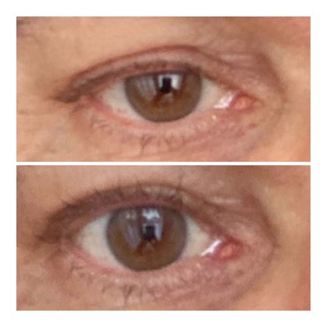 Eye Lift Wand – Topical Eye Lift Treatment Serum | SBLA Beauty