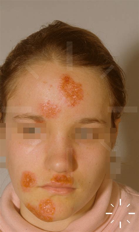 DermaCompass - Impetigo contagiosa