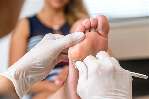 Callus reduction — Fitzroy Foot and Ankle Clinic