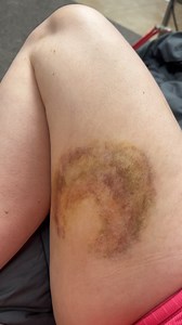 What gets rid of bruises fast | The Ryan And Amber Show