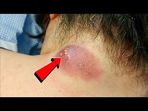 Drainage of Infected Epidermal Cyst: Full Procedure & Recovery