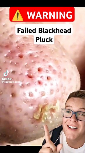 Explosive BLACKHEAD PLUCKING - Blackhead Removal Gone Wrong #shorts