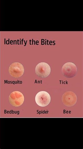 Insect Bites You Should Never Ignore 😳