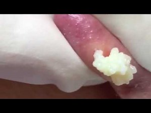 Cysts popping at home | Remove Blackhead on ear