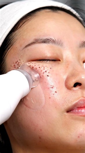 Satisfying blackhead removal and deep pore cleansing 🧖‍♀️✨