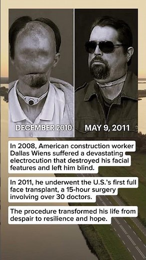 🌟 Life’s Battle & A Face Transplant — The Story of Dallas Wiens