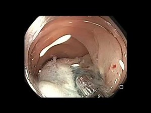 Colonoscopy: Sigmoid Colon Polyp Resection Using Orise Gel • Video • MEDtube.net
