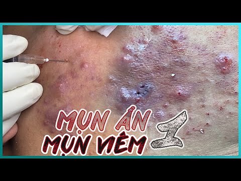 Big Cystic Acne Blackheads Extraction Blackheads & Milia, Whiteheads Removal Pimple Popping