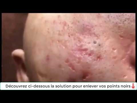 Compilation extraction de points noirs