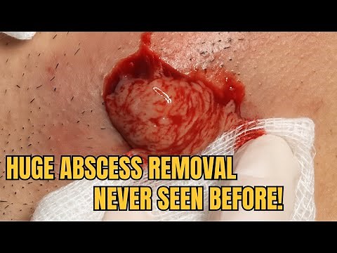 Satisfying Abscess Removal – Real Time Pus Release | Pimple Spa