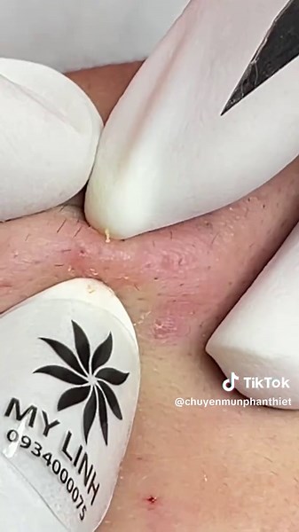 Vùng Cằm#linhmydang #acnetreatment #xuhuong #satisfying #blackhead #acne