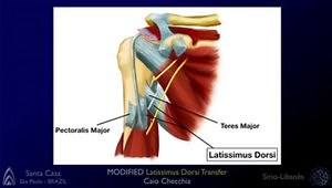 Allograft Enhanced Latissimus Dorsi Transfer for Irreparable Posterossuperior Rotator Cuff Tears