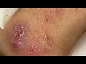 Loan Nguyen Acne Treatment 2212