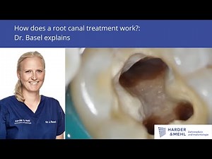 How does a root canal treatment work? - Dr. Basel explains