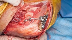 Treatment of a Chronic Elbow Dislocation with an Internal Fixator