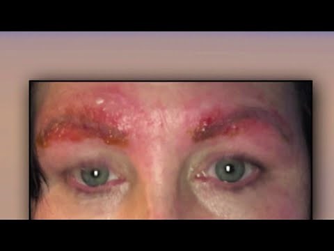 Risks of eyebrow microblading