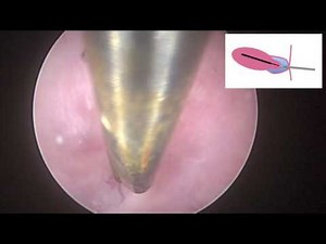 Hysteroscopic Management of a Stenotic Cervix