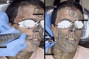 Time For A New Life: Dude Gets Full Face Tattoo Removal!