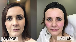 Our #TreatmentOfTheWeek is Belotero Dermal Fillers with Nurse Anna! 👩🏻‍⚕️This treatment is beneficial for those who have sagging skin, frown lines and thinning lips as a result of ageing. Belotero is the only highly cross-linked gel that can be injected in the most superficial layer of the dermis for even more natural, effective and long lasting results. It's safe, long-lasting and with immediate results! 🌟 To enquire about this treatment, contact one of our clinics! ☎️ Dublin: 01-6766527 ☎️ 