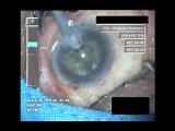Cataract Surgery VII - Part 3 • Video • MEDtube.net