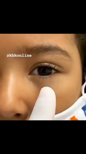 1.2K views | Conjunctival inclusion cysts are thin-walled benign cystic lesions, lined with a non-keratinizing epithelium containing serous fluid. They are usually symptomless but can cause cosmetic disfigurement, reduced motility, foreign body sensation and dry eye due to unstable tear film when they increase in size.#kbkfoundation | Kbkonline | Facebook