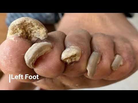 Toenail Fungus! DC Foot Doctor